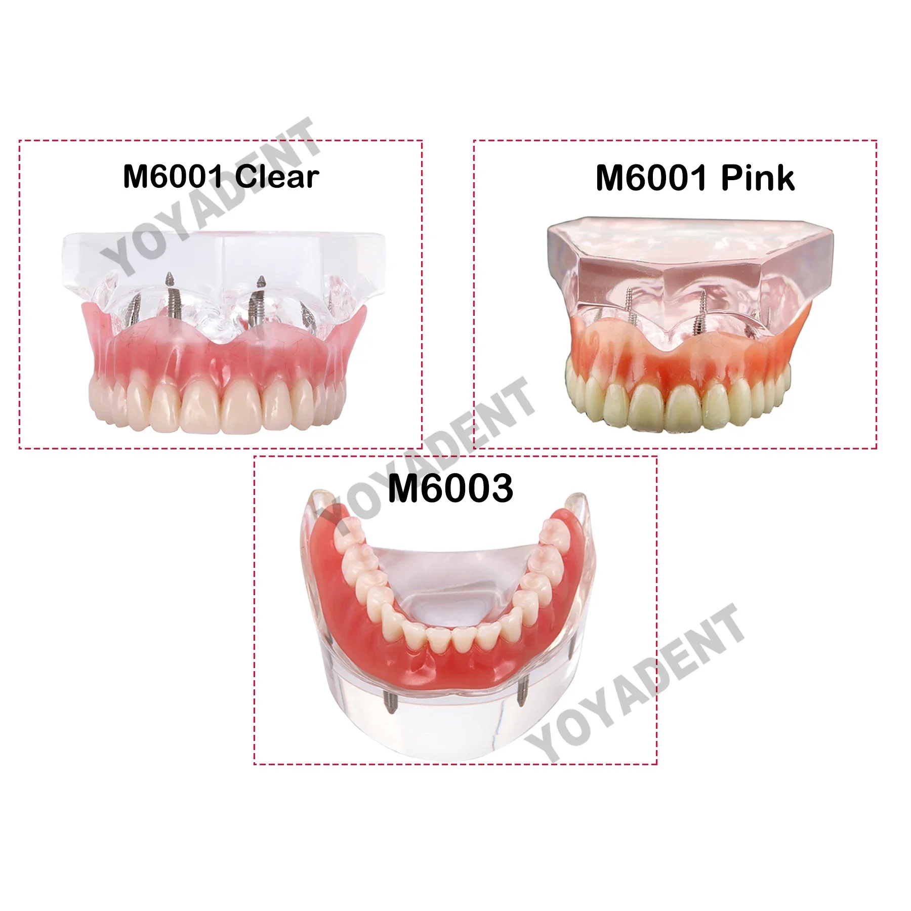 

Dental Teeth Model Teeth Teaching ModelWith 4 Implants Overdenture Removable Bridge for Dentist Patient Communication Treatment