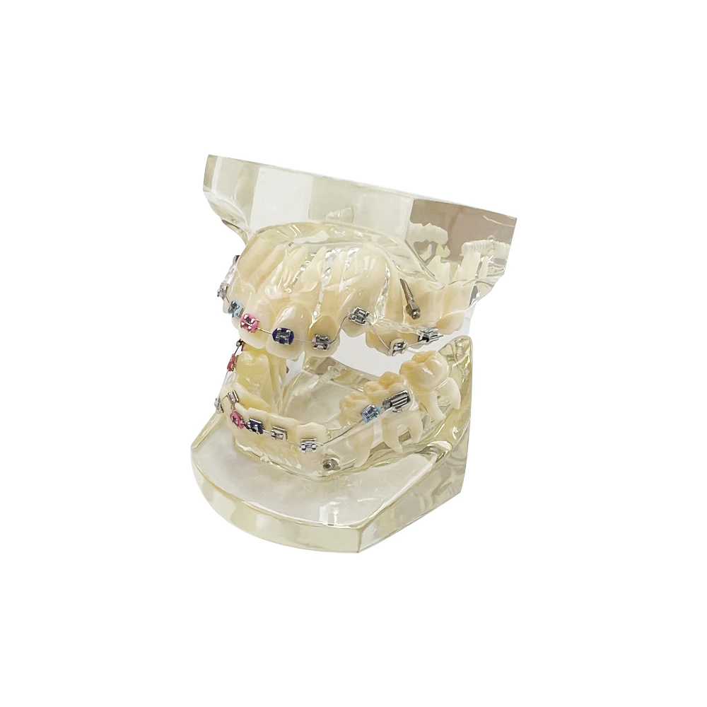 

Dental Orthodontic Model Teeth Teaching Model All Metal Bracket With Anchorage Ortho Model For Dentist-Patient Communication