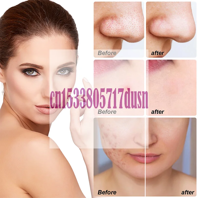 {HBA17} 1セット 大型ハイドロコロイドフルフェイスニキビパッチ ニキビ除去スキンフェイスクリーニング 鼻、顎、額、頬用