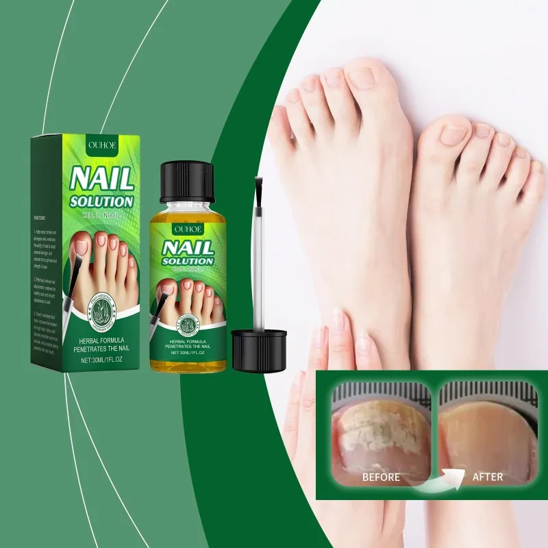 Suero para tratamiento de hongos en las uñas Extra fuerte, esencia de reparación de aceite, Gel antiinfección para dedos de los pies, crema para eliminar el cuidado de reparación de uñas