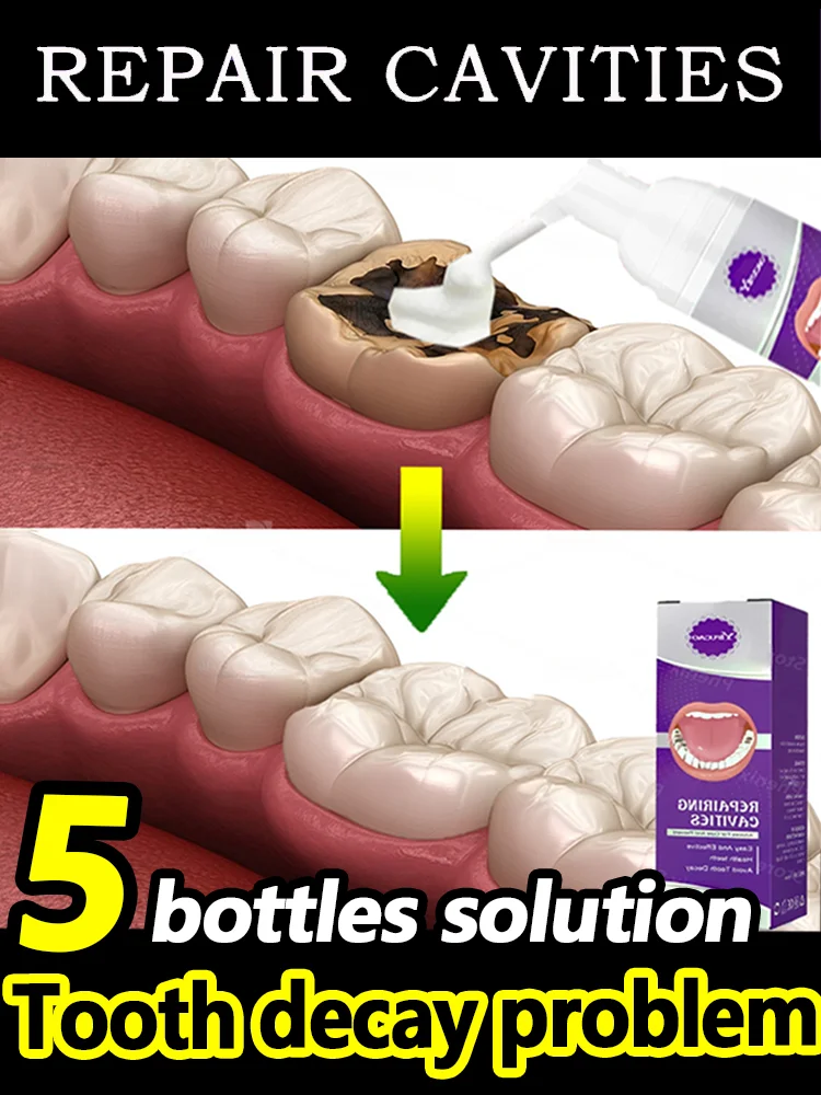 

Tooth decay Repair Repairing Cavities Anti Protecting Caries