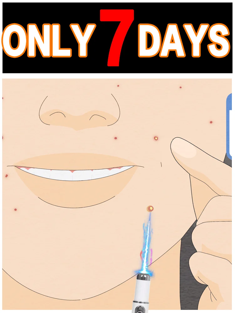 

Hot selling blue light pen accessories to solve body warts, wart care tools