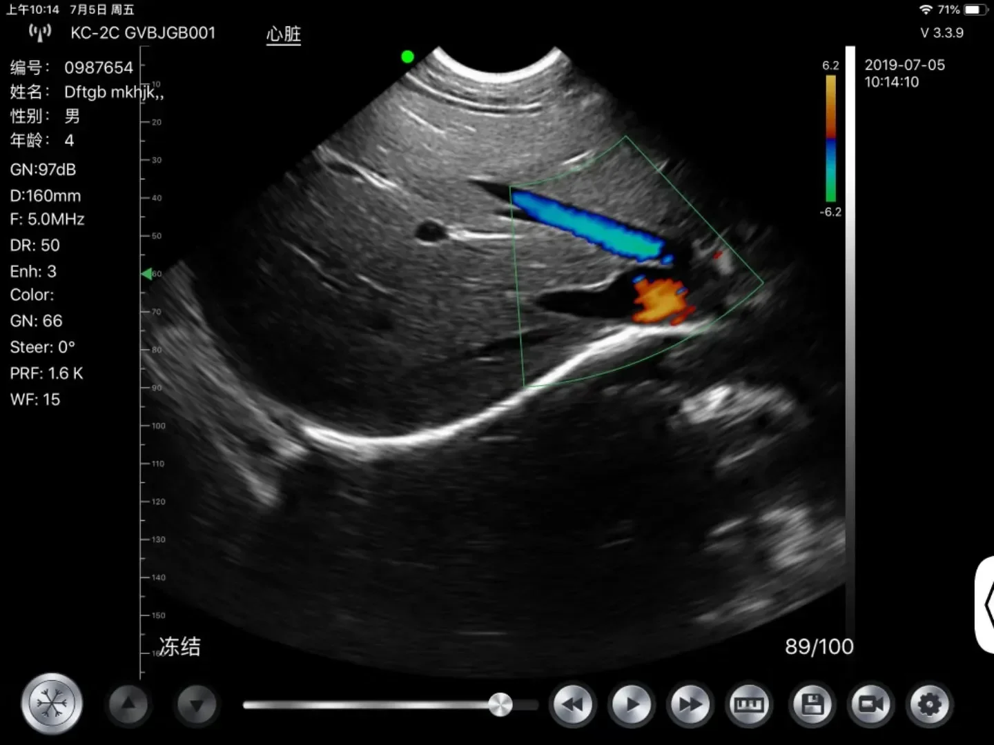 wireless probe microconvex ultrasound machine for sale