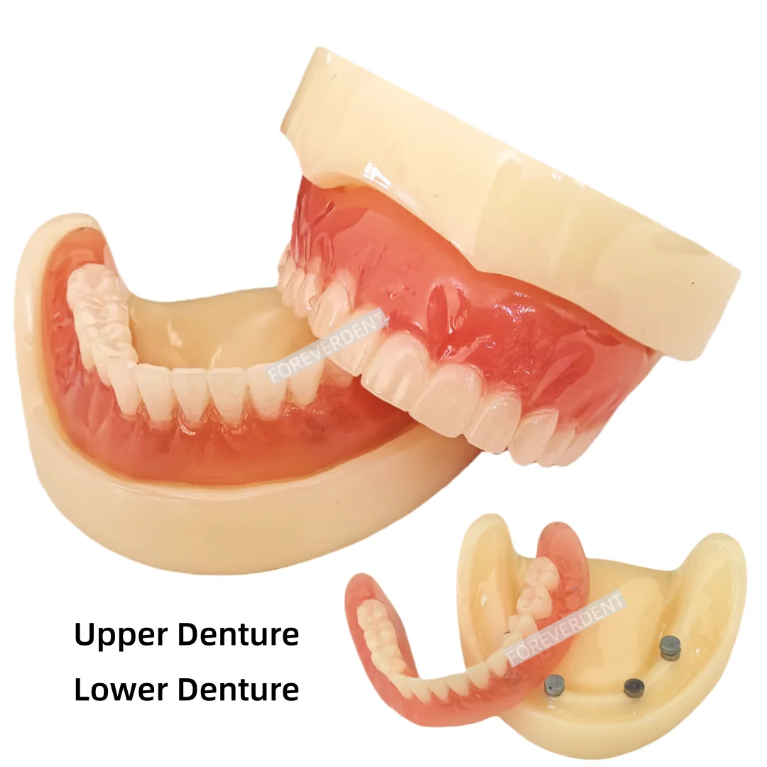 

Dental Full Denture Model Overdenture Magnetic Attachment Mandibular Upper Study