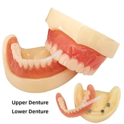 Dental Full Denture Model Overdenture Magnetic Attachment Mandibular Upper Study