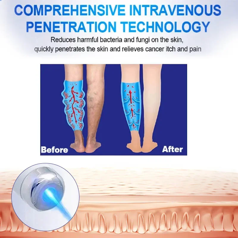 3Pcs Varicose Veins Laser Therapy Pen Relieve Legs Pain Varicose Vein Socks Leg Care For Men And Women Improve Blood Circulation