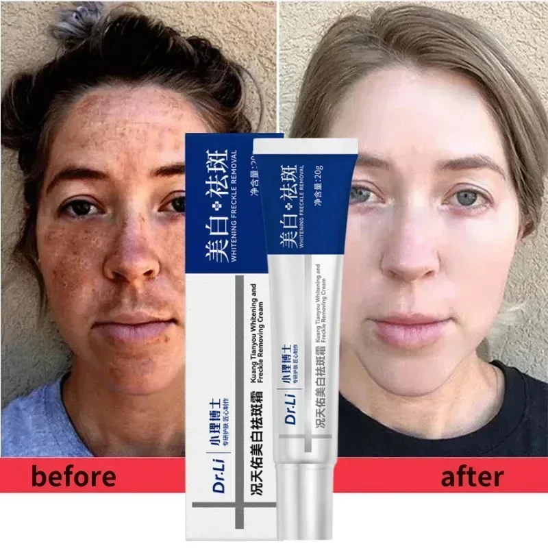 Freckle Whitening Cream Remove Melasma Dark Spots Fade Dark Spot Pigmentation Moisturize Brighten Face Korean Skin Care Product