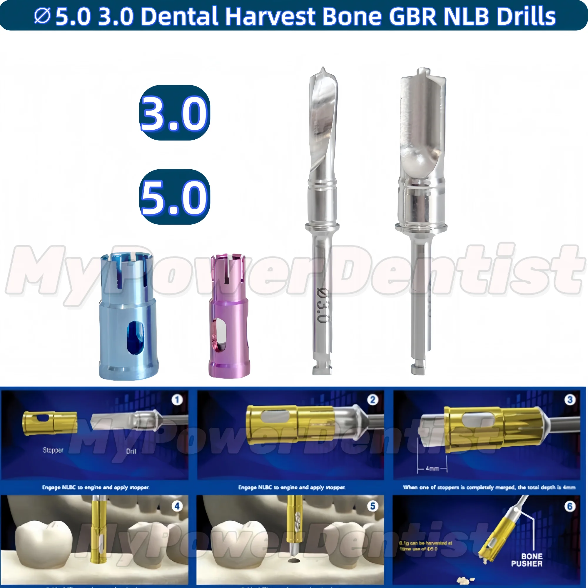 

Стоматологическая дрель для сбора костей Never Loss Trephine GBR NLB Drill 5.0 3.0