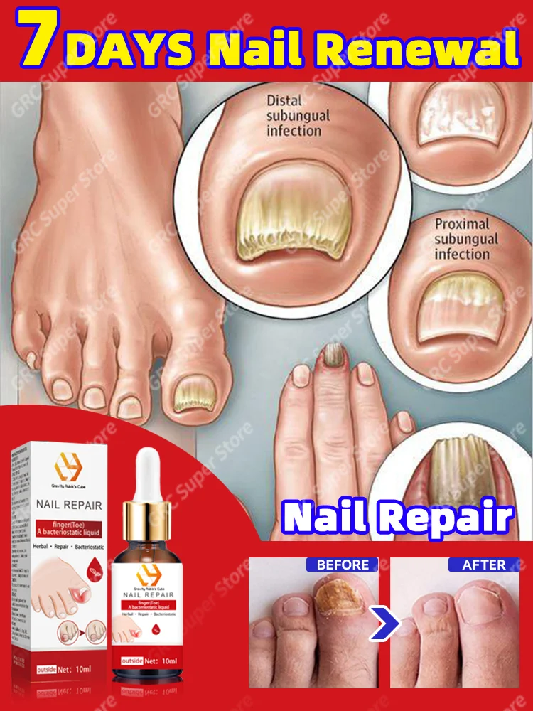 

Oil Products To Solving Nail trouble