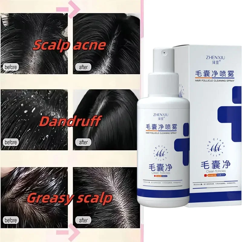 

Новый спрей для лечения кожи головы, удаление перхоти, зуд, контроль жирности, против выпадения кожи головы, восстанавливающая сыворотка, косметический уход за волосами, 30 мл