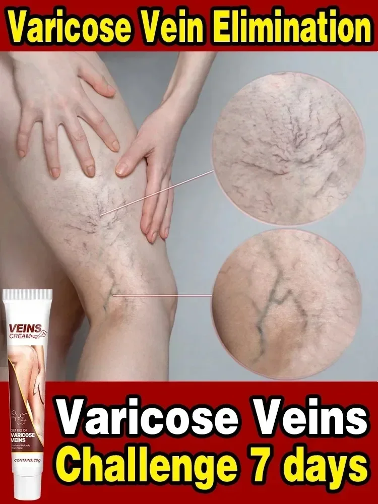 Varicose Vein Relief Paste Improve Blood Circulations Spider Varicose Vein For Tired Heavy Legs Fast Relief New