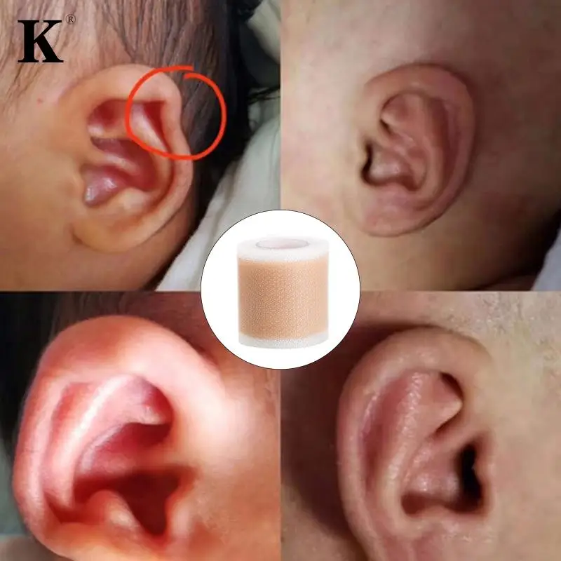 1Roll Baby Ear Corrector Infant Protruding Ears Correction 4x 50cm Silicone Kids Ear Aesthetic Correctors Patch Sticker Ear Care