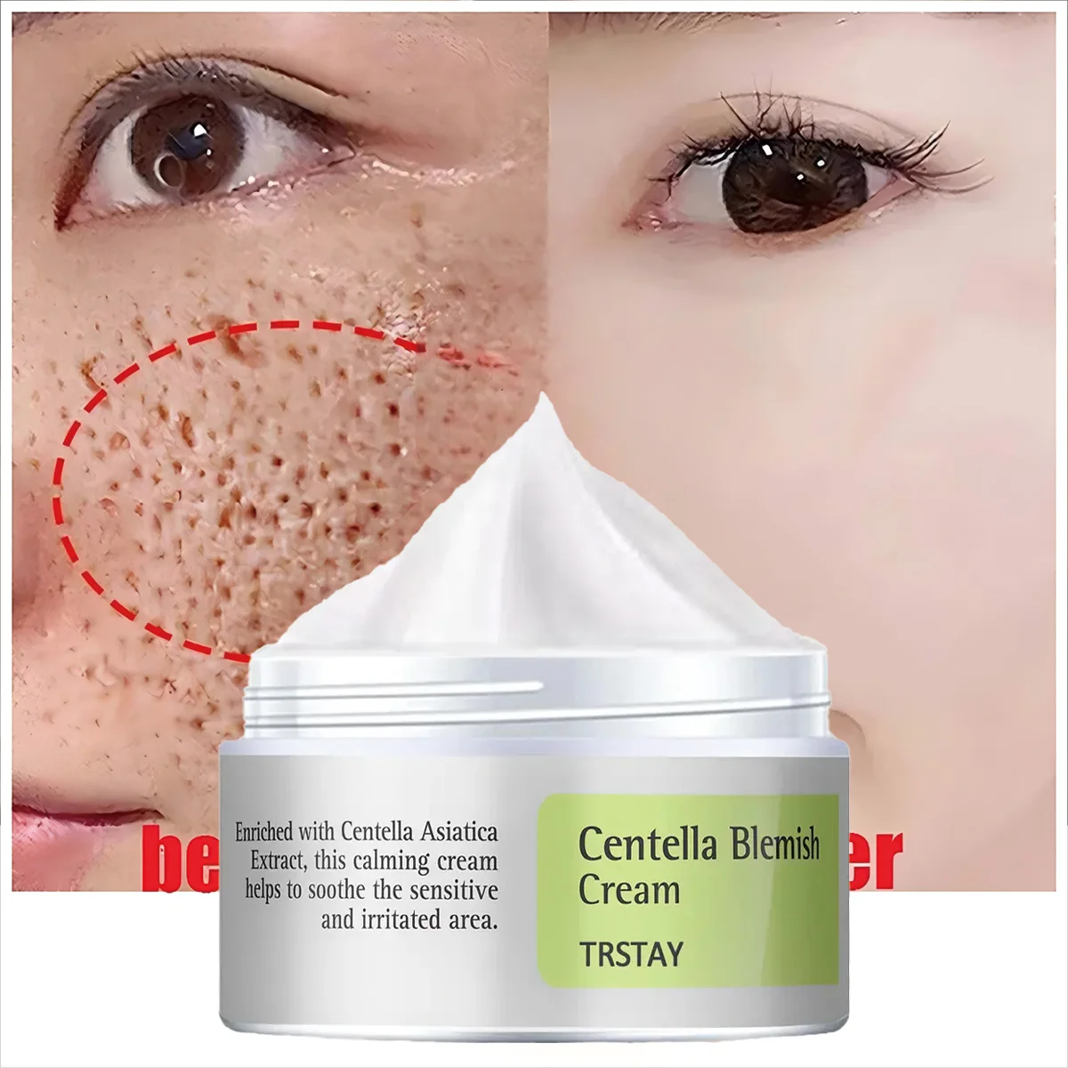 TRSTAY Centella Blemish Cream Rich in Extract for Soothing Sensitive Inflamed Areas Facial Skin Care for Mothers And Kids