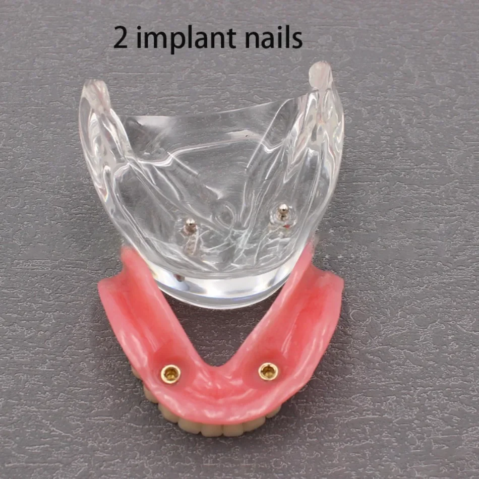 Dental Model: Mandibular Tooth 2-pin and 4-pin Implant Model for Doctor-patient Communication and Display Model