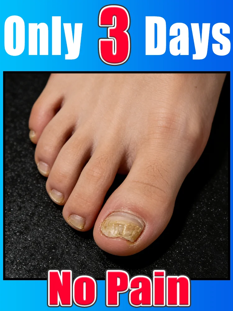 

Qᴜɪᴄᴋʟʏ ᴇʟɪᴍɪɴᴀᴛᴇ ғᴜɴɢᴜs ᴀɴᴅ ʀᴇsᴛᴏʀᴇ ʜᴇᴀʟᴛʜʏ ɴᴀɪʟs