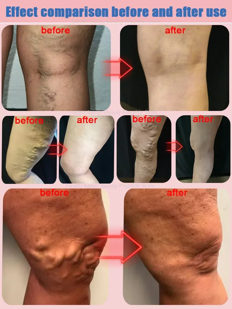 Laser varicose veins