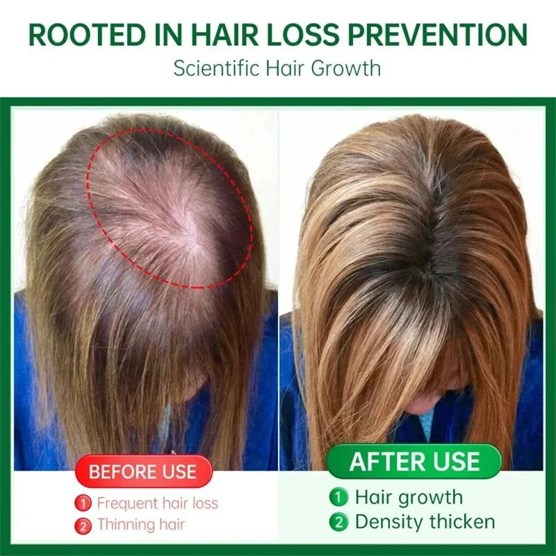 جوهر نمو الشعر السريع أفريقيا مجنون الجر الثعلبة مصل مكافحة كسر الشعر تخفيف القشرة وحكة فروة الرأس الشعر 30 مللي