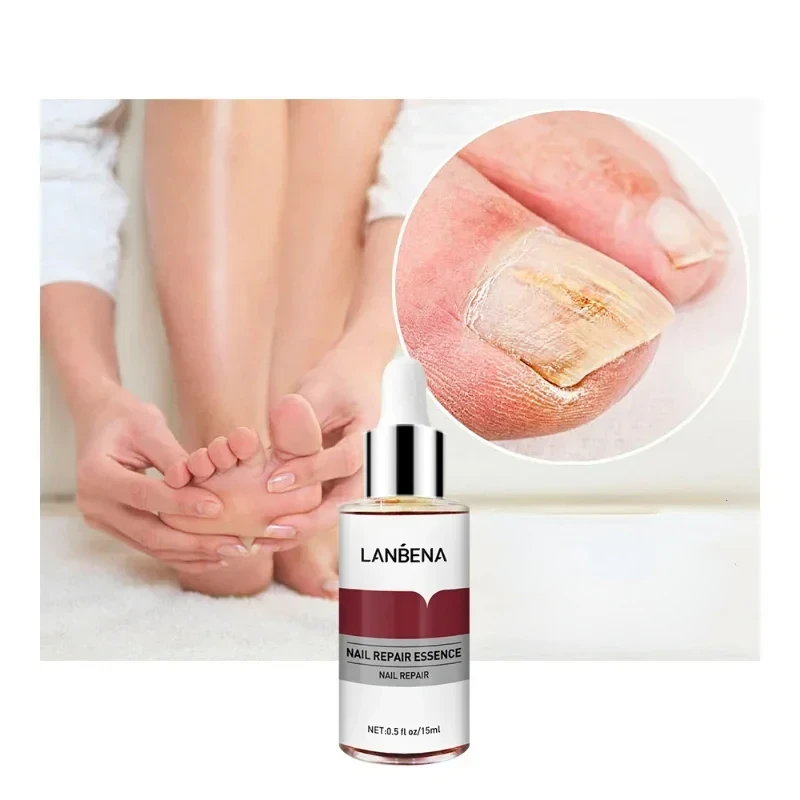 Fungal Nail Repair Essence Serum Anti Infection Paronychia Onychomycosis Treatment Care Foot Nail Fungus Removal Gel