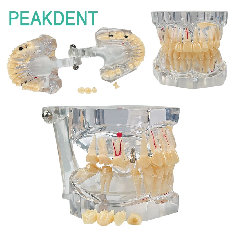 

Dental 2.5-fold Transparent Removable Pathology Model Oral Teaching Dental Implant Model Medical Disease Teaching Research Tool