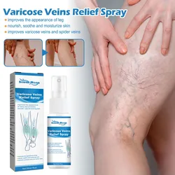 Spray for Varicose Veins Effective Varicose Vein Relief Cream To Relieve Leg Vasculitis Phlebitis Spider Pain Swelling Treatment