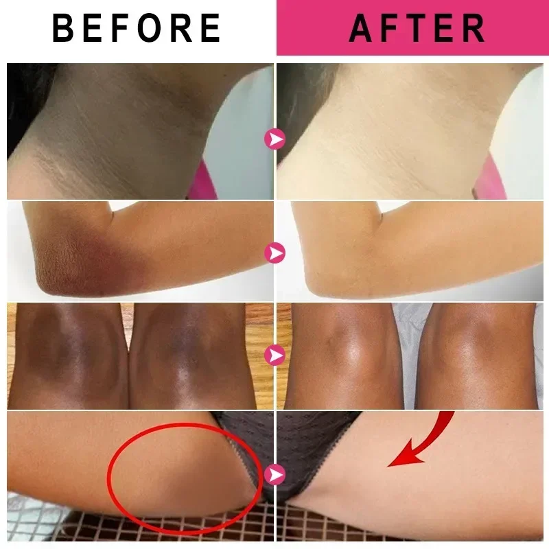 Crema iluminadora con vitamina C, blanqueador, melanina, zonas íntimas, blanqueamiento de piernas, rodillas, codos, brazos, ilumina la melanina