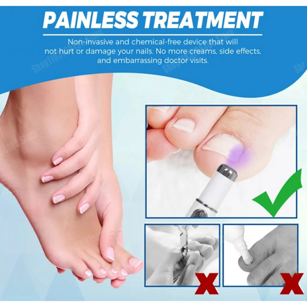 爪真菌レーザーペン 爪真菌クリーニングレーザー装置 爪真菌レーザー治療 損傷した変色した厚い足の爪