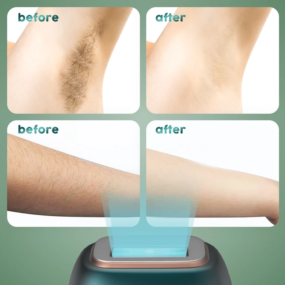 جهاز إزالة الشعر بالليزر المحمول من Sejoy IPL للنساء والرجال مع شاشة LCD للحماية من الحرارة الزائدة NTC