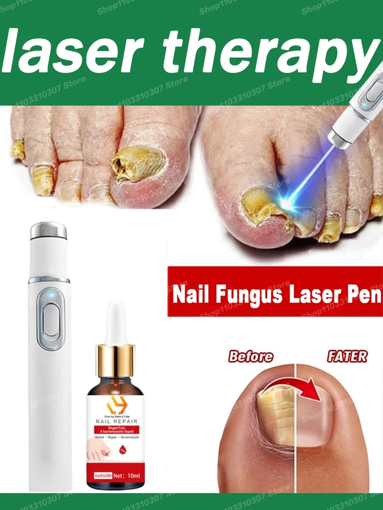 

Fungal Nail Laser Repair Fast Anti Infection Paronychia Onychomycosis Ingrown Toenail Foot Care