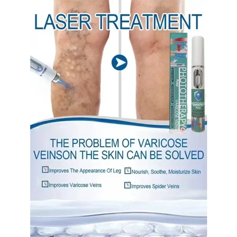 Laser vein | painless treatment of varicose veins | Relieve spider leg pain