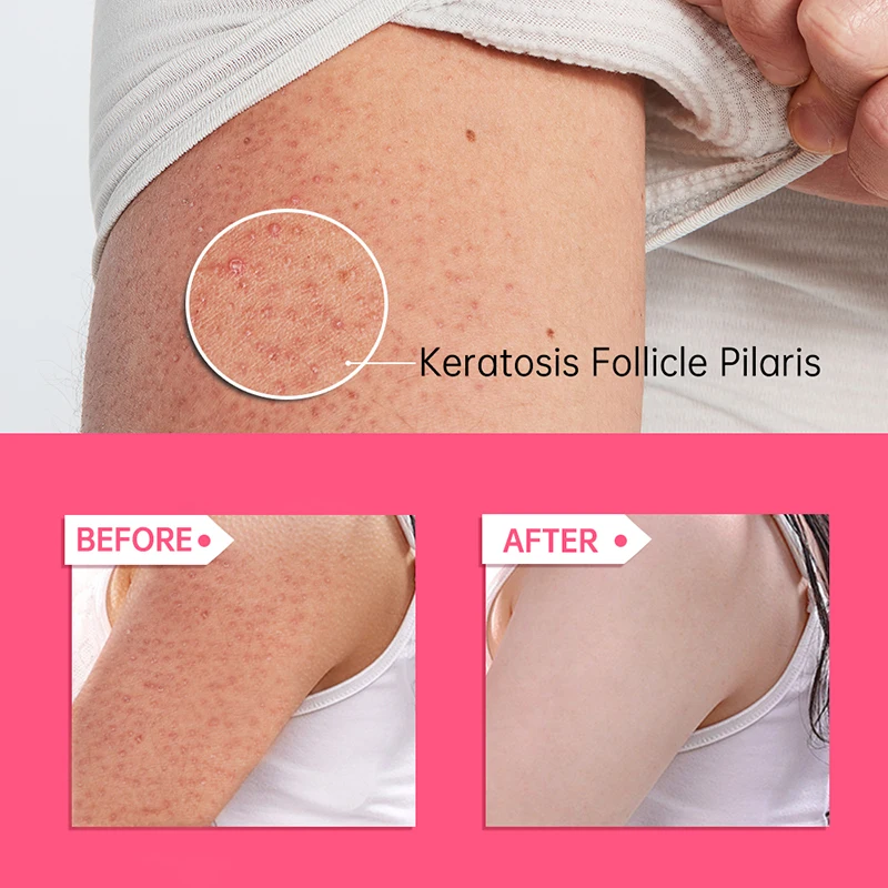 ครีมบำรุงผิว60กรัมครีมบำรุงผิวไก่ Keratosis Pilaris โลชั่นเพิ่มความชุ่มชื้นดูแลรูขุมขนเป็นหลุมเป็นบ่อ