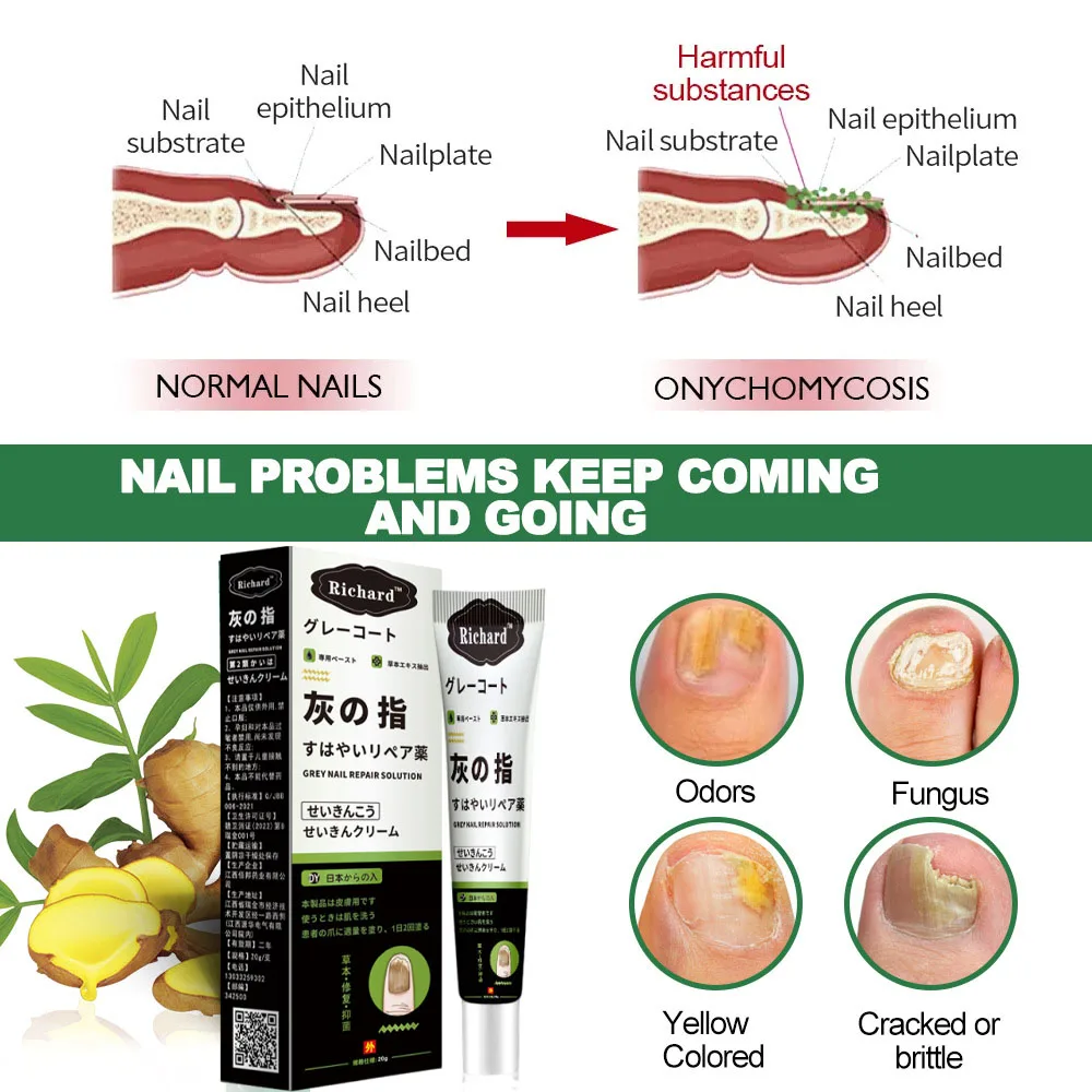 كريم علاج فطريات الأظافر القدم تو إزالة فطريات الأظافر زيت طبيعي مكافحة العدوى فطار الداحس إصلاح الرعاية #6