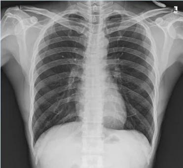 Hot Sale High Frequency Mobile Equipment Medical X-ray Machine