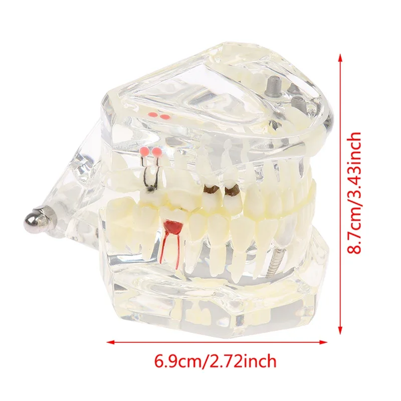 1pc Dental Model Teeth Implant Restoration Bridge Teaching for Study Tooth Science
