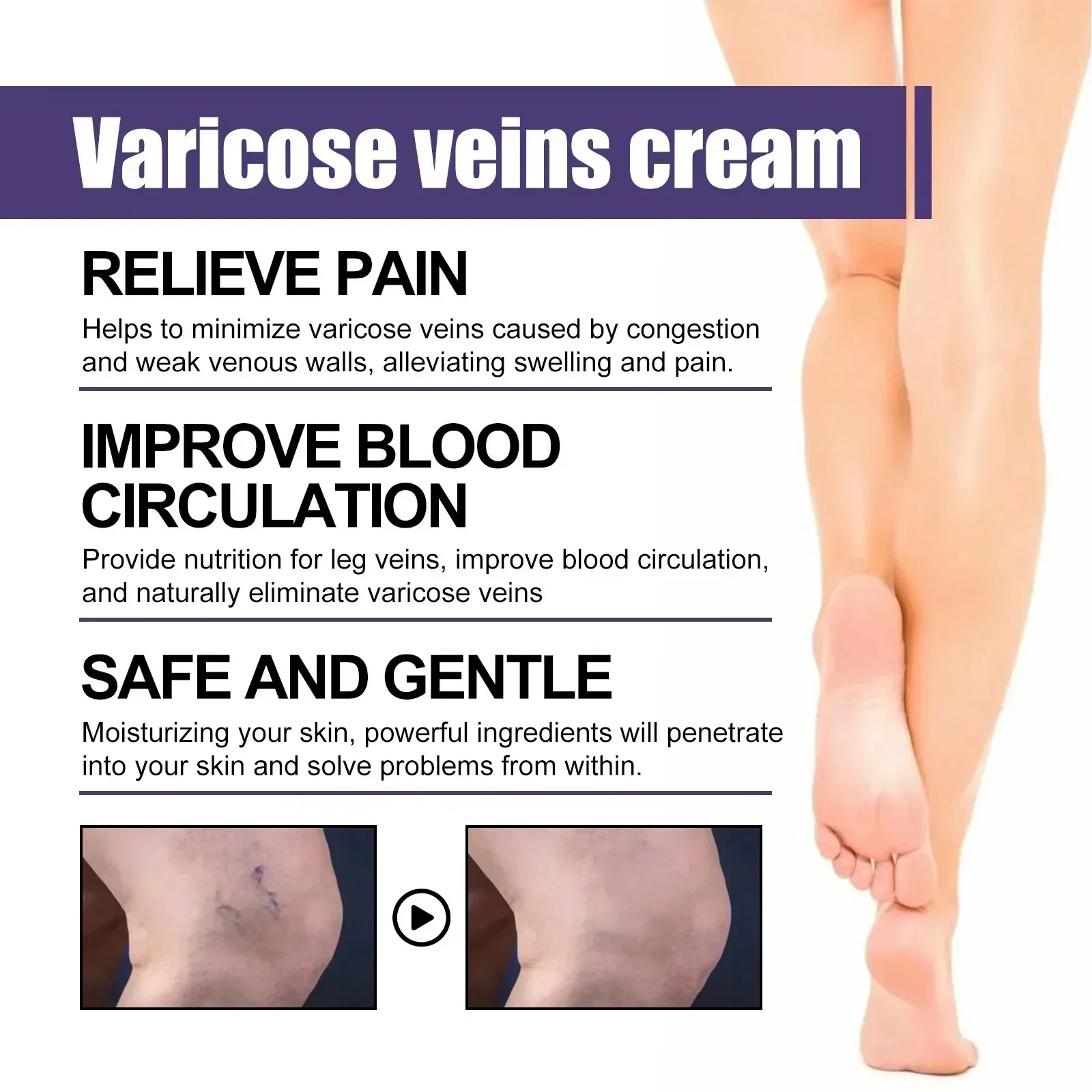 Effective Varicose Vein Relief Cream Ointment Leg Vasculitis Phlebitis Spider Shape Vein Pain Relief Ointment Angiitis Removal