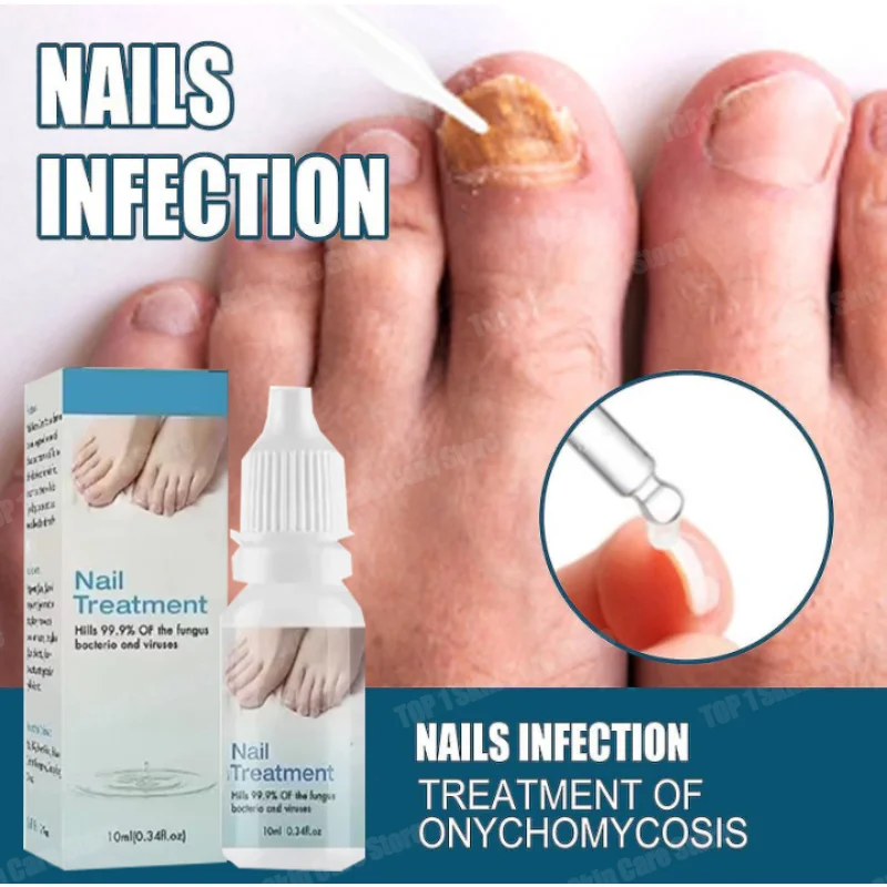 HOT SALE 10ml Onychomycosis Repair Serum Ointment Onychomycosis Paronychia Care Cream Nail Toenail Foot Care Repair