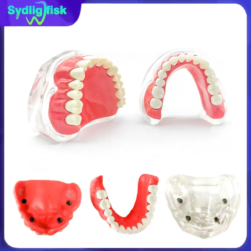 1Pcs Dental Implant Model Maxillary Mandibular Removable 4 Implant Overdenture Restoration Teeth Model Demonstration Model