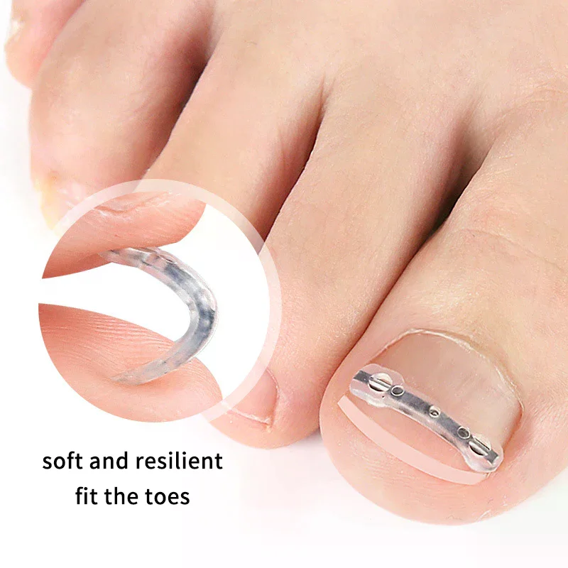 Autocollants de Correction des ongles incarnés élastiques, 2 pièces, patchs auxiliaires invisibles, traitement Paronychia, récupération