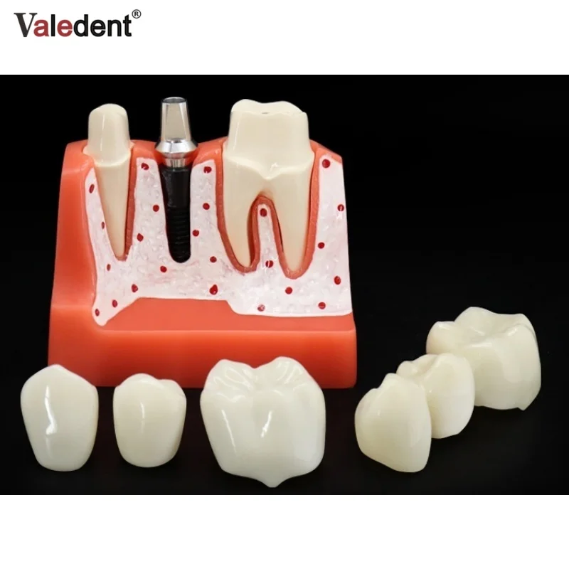 Dental Implant Model Magnified Caries Contrast Tooth Model Crown Dental Implant Models for Doctor-patient Communication