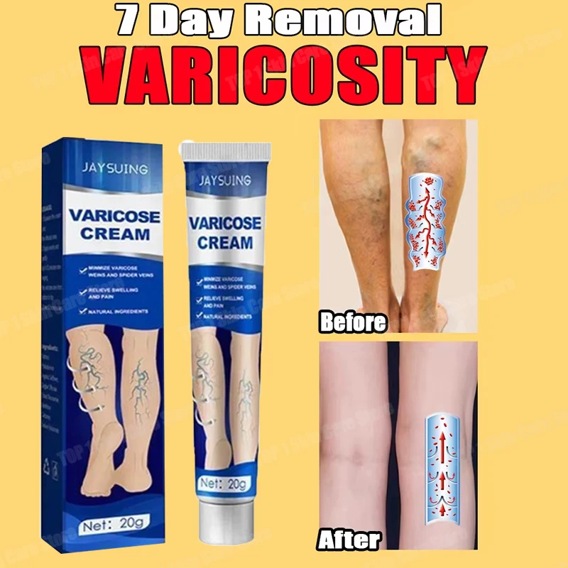 

Varicose Vein Treatment Ointment Relieves Leg Fatigue, Dilated Vasculitis, Venositis, Spider Pain Relief Ointment, Body Ointment