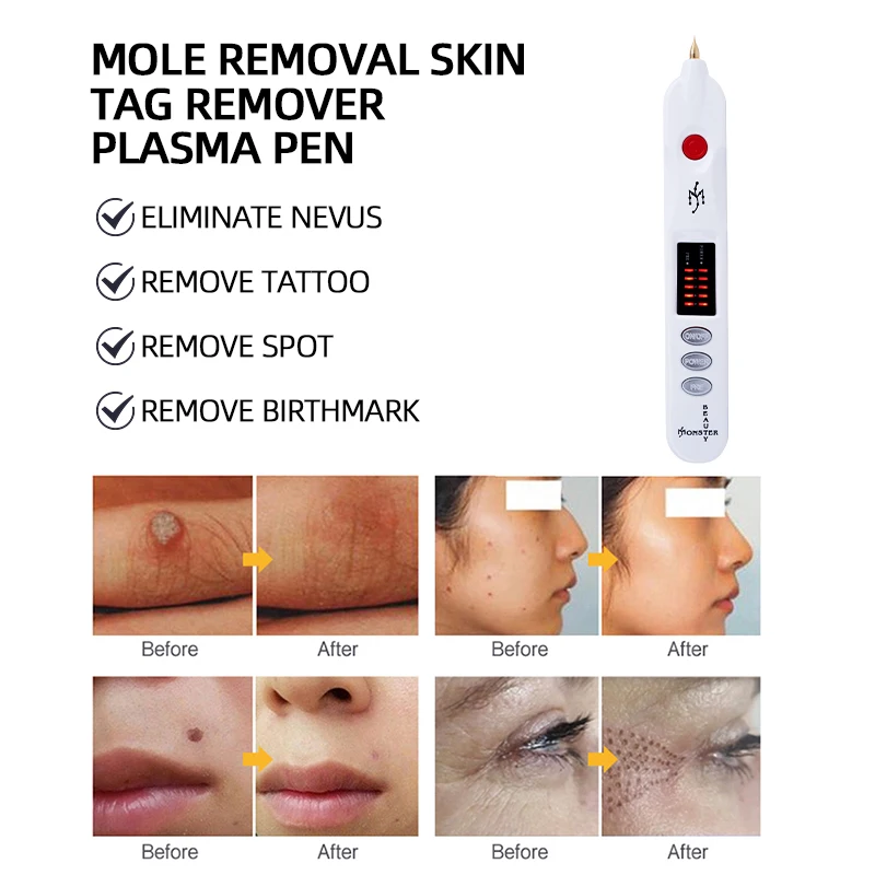 Stylo plasma d'élimination des grains de beauté, élimination des points noirs, pigmentation, tatouage, papillome, élimination des verrues, outil de soins de la peau V