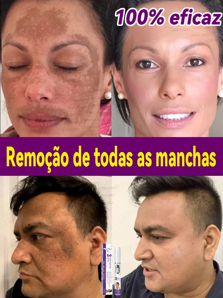 laser nano Pontos faciais se foram