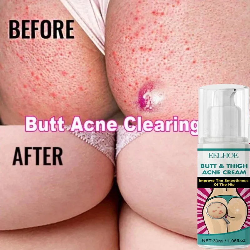 Body Acne Treatment Cream Clearing Dark Spots Pimples Moisturizing Lotion Butt Inner Thigh Whitening Serum Buttock Smooth Cream