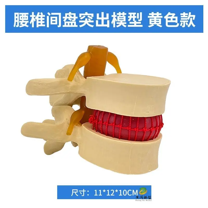 Teaching Human Spine Model Spinal Bones Lumbar Disc Mould Vertebral Herniation Compression Pathology Bone Teaching Aids
