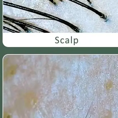 多機能頭皮皮膚毛包検出器 HD 視覚的な皮膚分析機械拡大鏡皮膚鏡電話タブレット接続