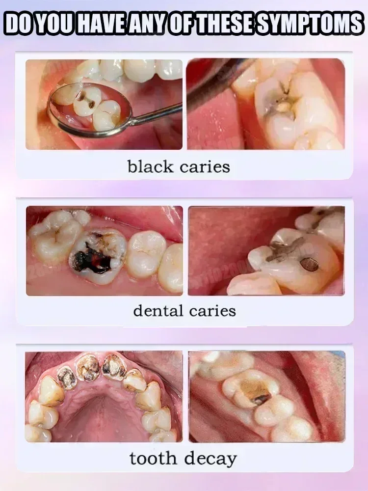 Ventas calientes Más vendido, reparaciones científicas de caries, elimina caries, limpia la placa, blanquea los dientes y refresca el aliento