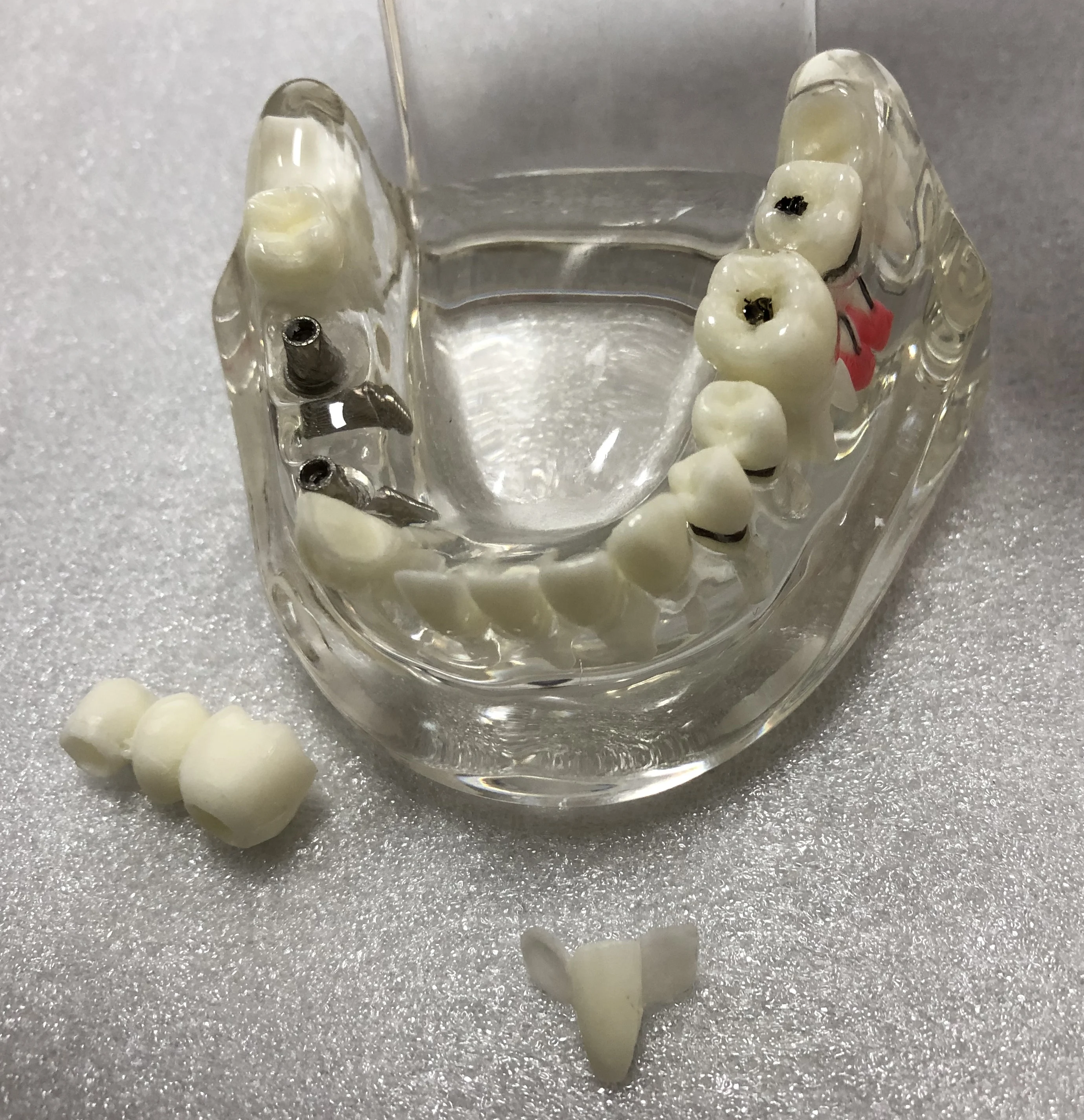 A2001 Clear Dentals Implants Model Prosthetic Pathological Study Education Model