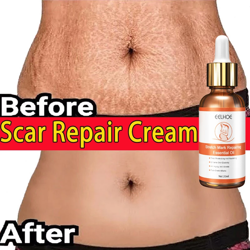 Stretch Marks Permanent Removal Serum Effective Treatment Stretch Marks Burn Surgical Scars Anti-Aging Firming Smooth Body Care