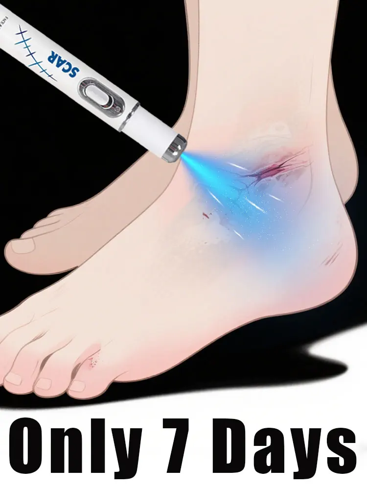 

Blue light pen solve scar, best-selling product in Asia