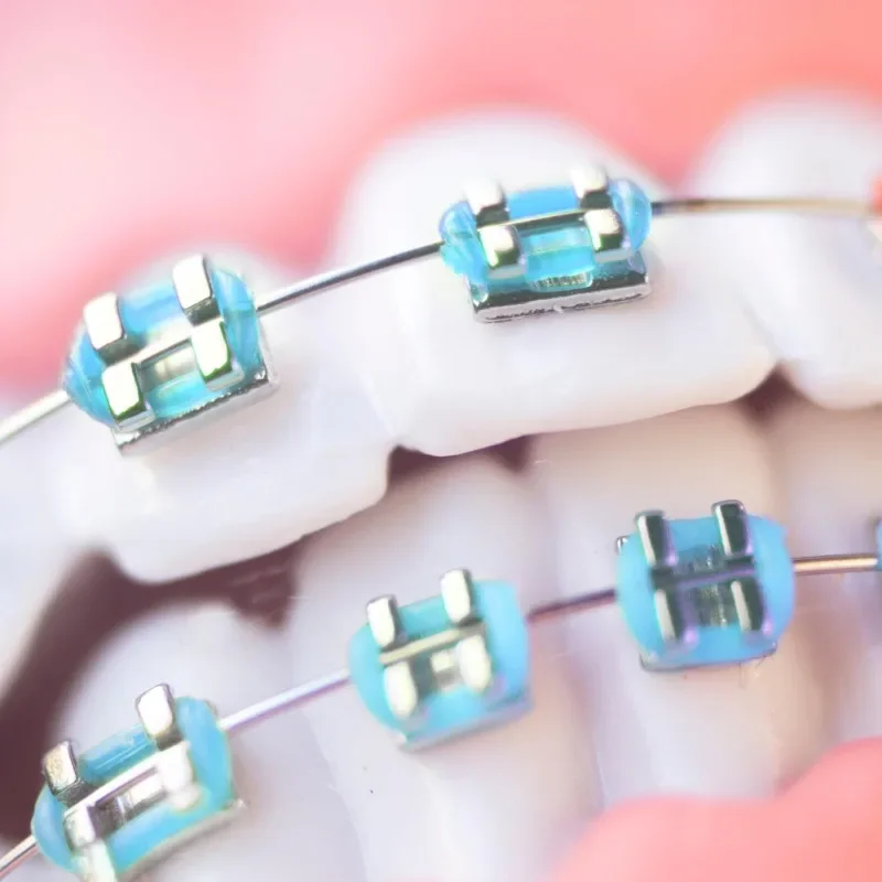 1 Paar Modische Zahnspangen Bunte Temporäre Zahndekoration mit Metalldrähten Metallhalterung Kieferorthopädische Ligaturen Hohe Qualität – Detail 3