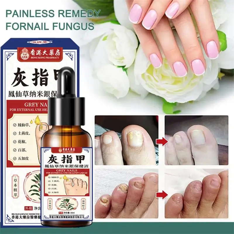 Nail Fungus Treatment Serum Foot Repair Liquid Toe Nails Fungal Removal Gel Anti Infection Paronychia Onychomycosis Cream 30ml
